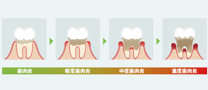 歯周病は骨の病気 信濃町 四谷三丁目の歯医者 赤羽歯科 信濃町診療所 土日祝日診療